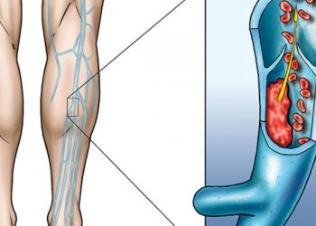 TROMBOSI: SE LA CONOSCI, LA EVITI