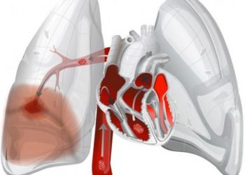 EMBOLIA POLMONARE: UN KILLER SILENZIOSO
