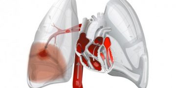 EMBOLIA POLMONARE: UN KILLER SILENZIOSO