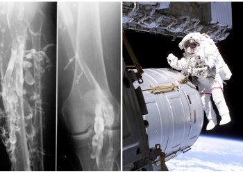 Sindrome da classe economica e trombosi nello spazio