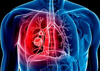 Una trombosi di una vena può causare una Tromboembolia Polmonare, una patologia subdola e pericolosa, in molti casi mortale!