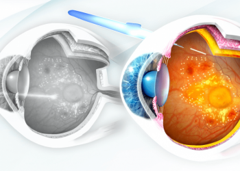 Retinopatia diabetica, lo screening può salvare la vista di un milione di italiani